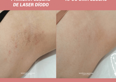 Depilação Laser - Estética Madeira