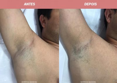 Depilação Laser - Estética Madeira