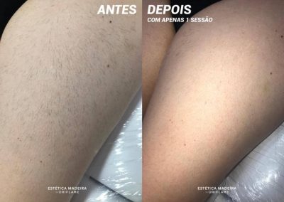 Depilação Laser - Estética Madeira