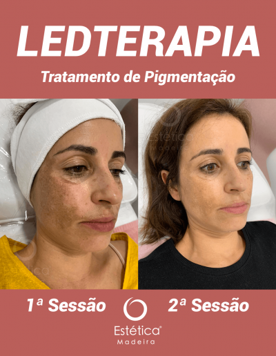 Ledterapia - Tratamento de Pigmentação