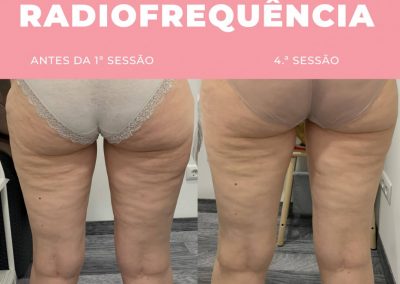 Radiofrequência - Lipoaspiração não invasiva