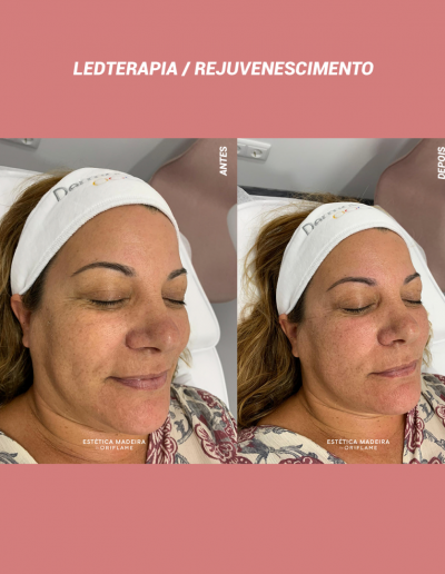 Ledterapia